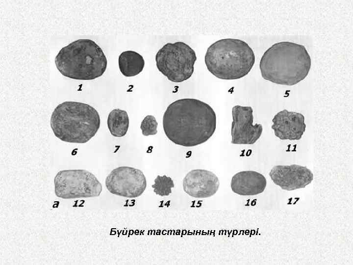 Бүйрек тастарының түрлері. 