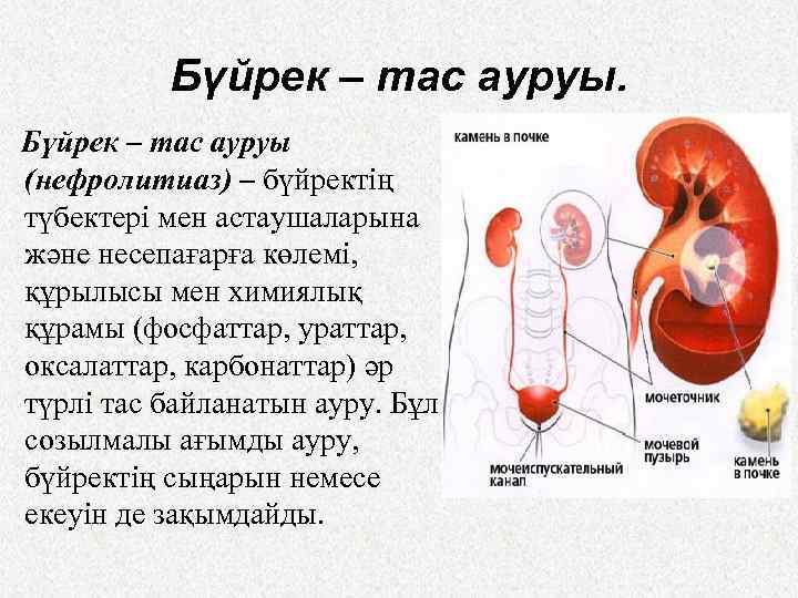 Бүйрек – тас ауруы (нефролитиаз) – бүйректің түбектері мен астаушаларына және несепағарға көлемі, құрылысы