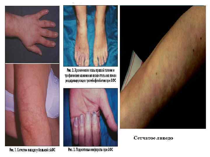 Сетчатое ливедо 