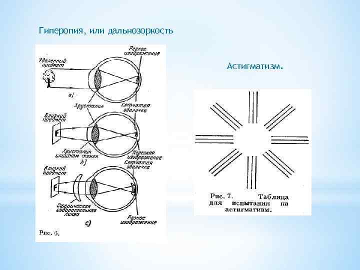 Гиперопия, или дальнозоркость Астигматизм. 