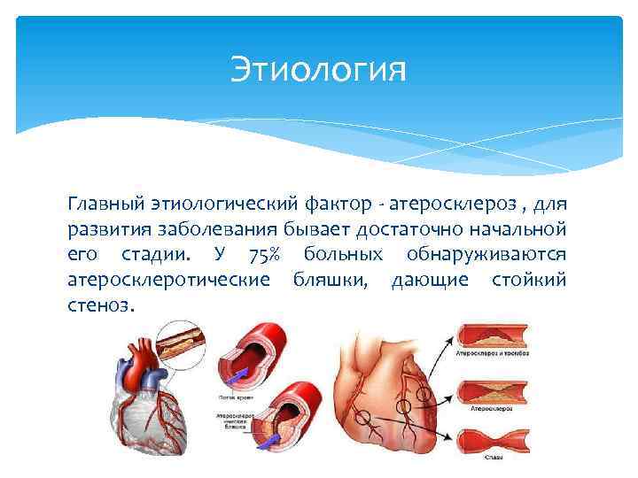 Стабильная стенокардия презентация