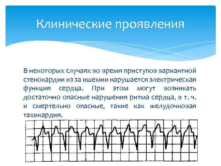 Стенокардия характеризующаяся постоянной картиной приступов