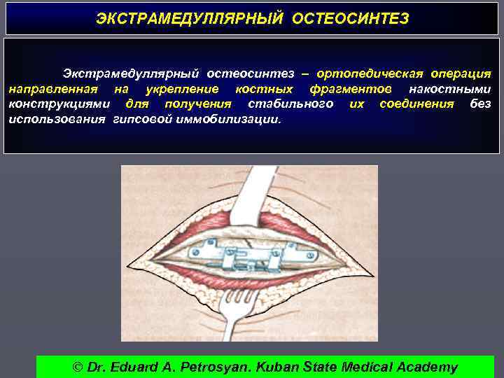 ЭКСТРАМЕДУЛЛЯРНЫЙ ОСТЕОСИНТЕЗ Экстрамедуллярный остеосинтез – ортопедическая операция направленная на укрепление костных фрагментов накостными конструкциями
