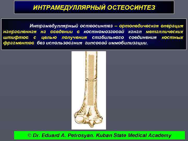 ИНТРАМЕДУЛЛЯРНЫЙ ОСТЕОСИНТЕЗ Интрамедуллярный остеосинтез – ортопедическая операция направленная на введении в костномозговой канал металлических