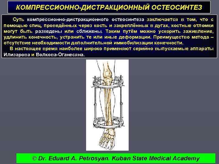 КОМПРЕССИОННО-ДИСТРАКЦИОННЫЙ ОСТЕОСИНТЕЗ Суть компрессионно-дистракционного остеосинтеза заключается в том, что с помощью спиц, проведённых через