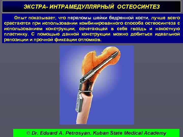 ЭКСТРА- ИНТРАМЕДУЛЛЯРНЫЙ ОСТЕОСИНТЕЗ Опыт показывает, что переломы шейки бедренной кости, лучше всего срастаются при