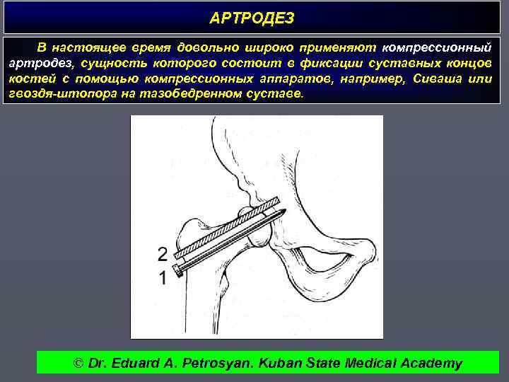 АРТРОДЕЗ В настоящее время довольно широко применяют компрессионный артродез, сущность которого состоит в фиксации