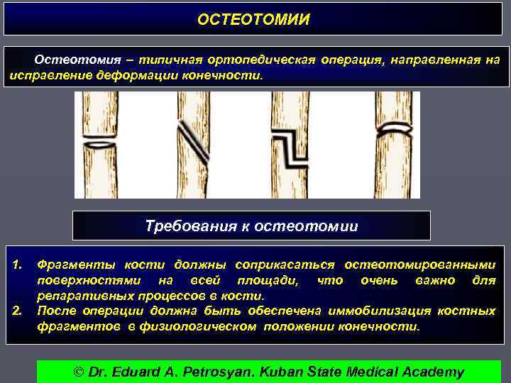ОСТЕОТОМИИ Остеотомия – типичная ортопедическая операция, направленная на исправление деформации конечности. Требования к остеотомии