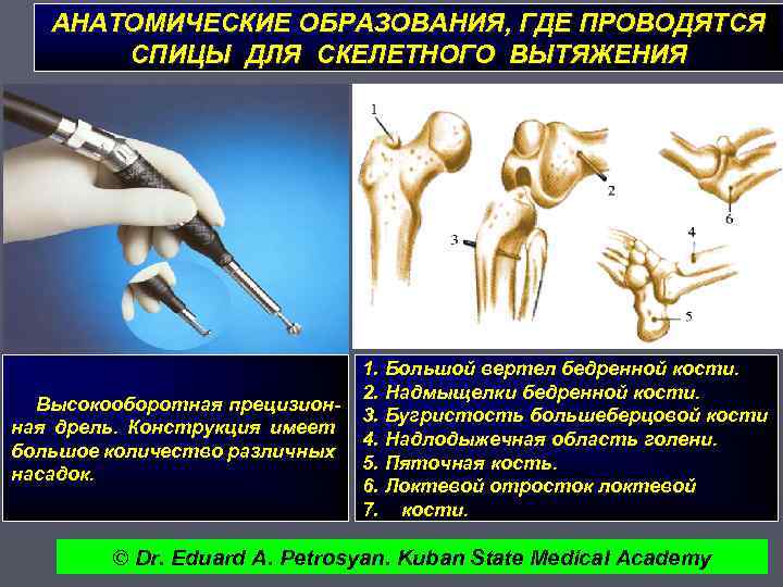 АНАТОМИЧЕСКИЕ ОБРАЗОВАНИЯ, ГДЕ ПРОВОДЯТСЯ СПИЦЫ ДЛЯ СКЕЛЕТНОГО ВЫТЯЖЕНИЯ Высокооборотная прецизионная дрель. Конструкция имеет большое