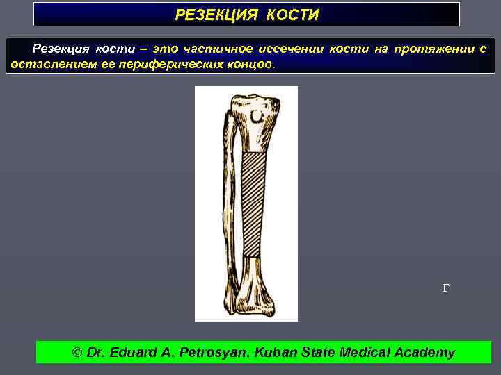 РЕЗЕКЦИЯ КОСТИ Резекция кости – это частичное иссечении кости на протяжении с оставлением ее