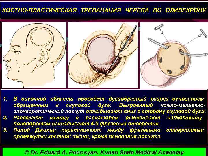 КОСТНО-ПЛАСТИЧЕСКАЯ ТРЕПАНАЦИЯ ЧЕРЕПА ПО ОЛИВЕКРОНУ 1. 2. 3. В височной области проводят дугообразный разрез