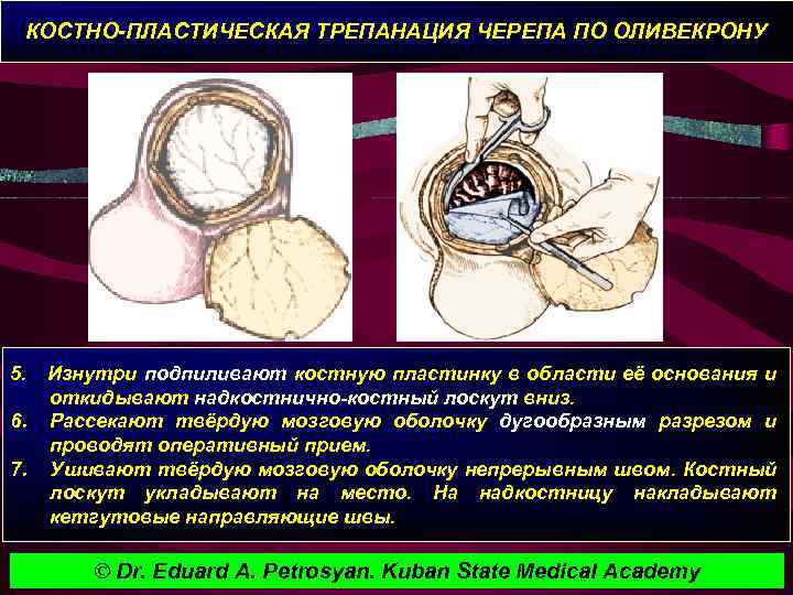 КОСТНО-ПЛАСТИЧЕСКАЯ ТРЕПАНАЦИЯ ЧЕРЕПА ПО ОЛИВЕКРОНУ 5. Изнутри подпиливают костную пластинку в области её основания