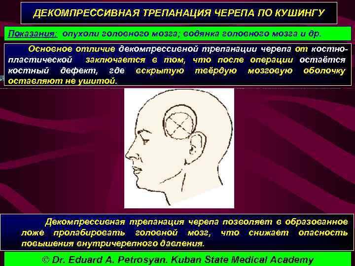 ДЕКОМПРЕССИВНАЯ ТРЕПАНАЦИЯ ЧЕРЕПА ПО КУШИНГУ Показания: опухоли головного мозга; водянка головного мозга и др.