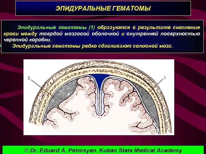 ЭПИДУРАЛЬНЫЕ ГЕМАТОМЫ Эпидуральные гематомы (1) образуются в результате скопления крови между твердой мозговой оболочкой