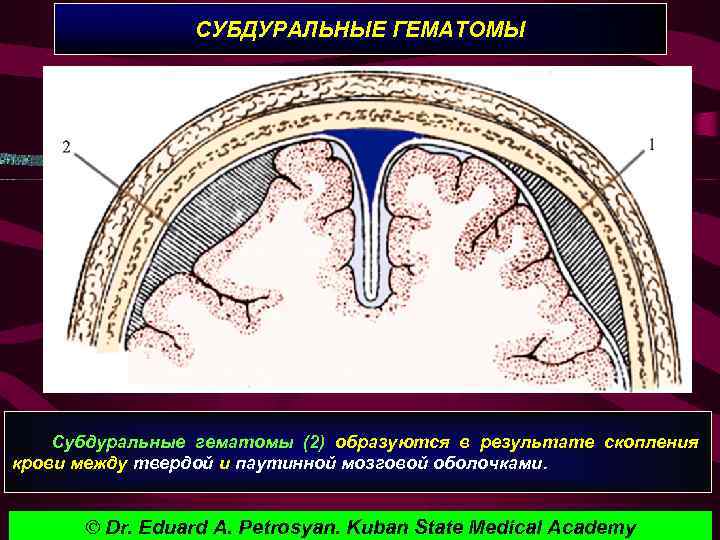 СУБДУРАЛЬНЫЕ ГЕМАТОМЫ Субдуральные гематомы (2) образуются в результате скопления крови между твердой и паутинной