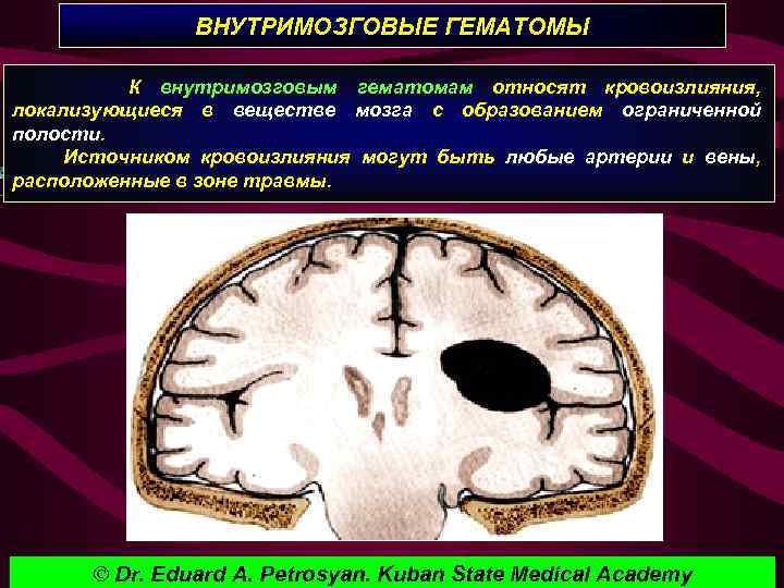 ВНУТРИМОЗГОВЫЕ ГЕМАТОМЫ К внутримозговым гематомам относят кровоизлияния, локализующиеся в веществе мозга с образованием ограниченной