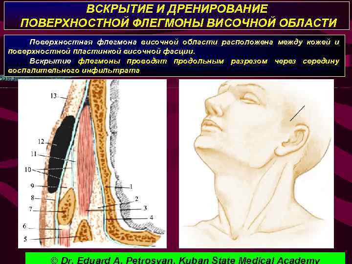 ВСКРЫТИЕ И ДРЕНИРОВАНИЕ ПОВЕРХНОСТНОЙ ФЛЕГМОНЫ ВИСОЧНОЙ ОБЛАСТИ Поверхностная флегмона височной области расположена между кожей