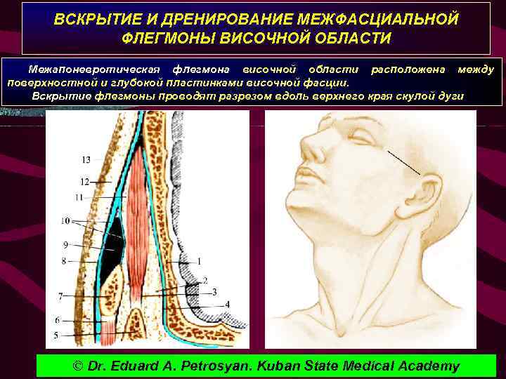 ВСКРЫТИЕ И ДРЕНИРОВАНИЕ МЕЖФАСЦИАЛЬНОЙ ФЛЕГМОНЫ ВИСОЧНОЙ ОБЛАСТИ Межапоневротическая флегмона височной области расположена между поверхностной