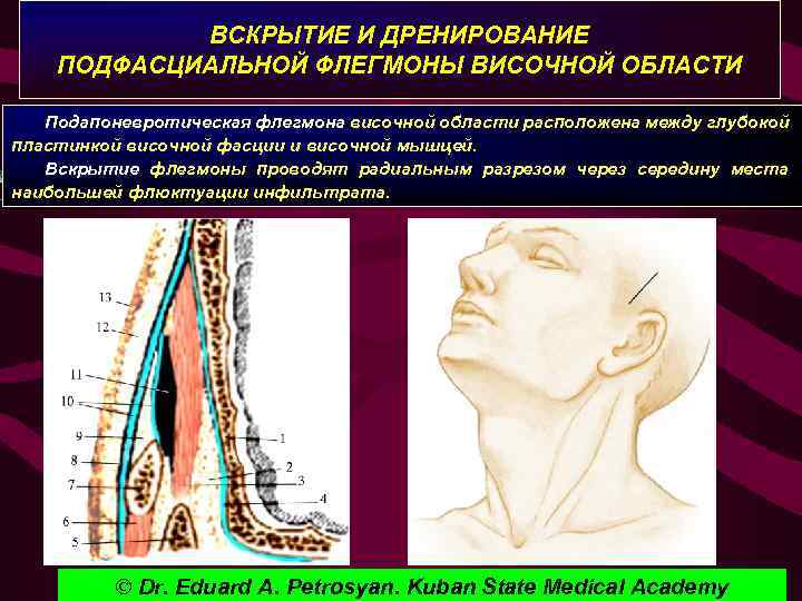 ВСКРЫТИЕ И ДРЕНИРОВАНИЕ ПОДФАСЦИАЛЬНОЙ ФЛЕГМОНЫ ВИСОЧНОЙ ОБЛАСТИ Подапоневротическая флегмона височной области расположена между глубокой