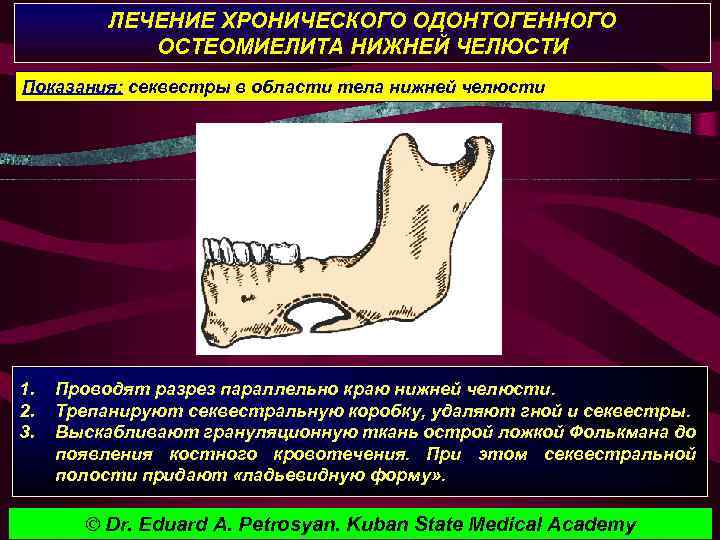 ЛЕЧЕНИЕ ХРОНИЧЕСКОГО ОДОНТОГЕННОГО ОСТЕОМИЕЛИТА НИЖНЕЙ ЧЕЛЮСТИ Показания: секвестры в области тела нижней челюсти 1.