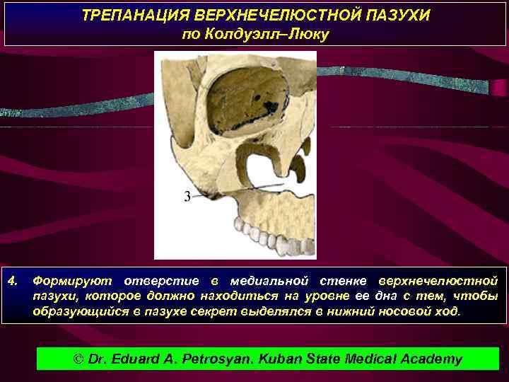 ТРЕПАНАЦИЯ ВЕРХНЕЧЕЛЮСТНОЙ ПАЗУХИ по Колдуэлл–Люку 4. Формируют отверстие в медиальной стенке верхнечелюстной пазухи, которое