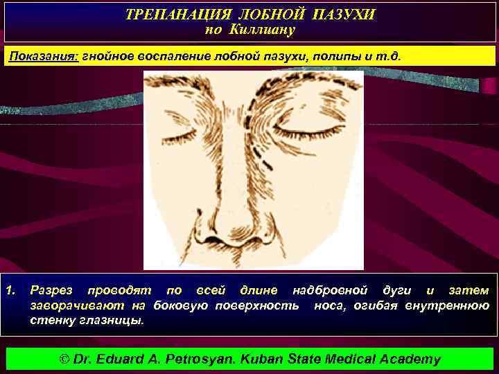ТРЕПАНАЦИЯ ЛОБНОЙ ПАЗУХИ по Киллиану Показания: гнойное воспаление лобной пазухи, полипы и т. д.