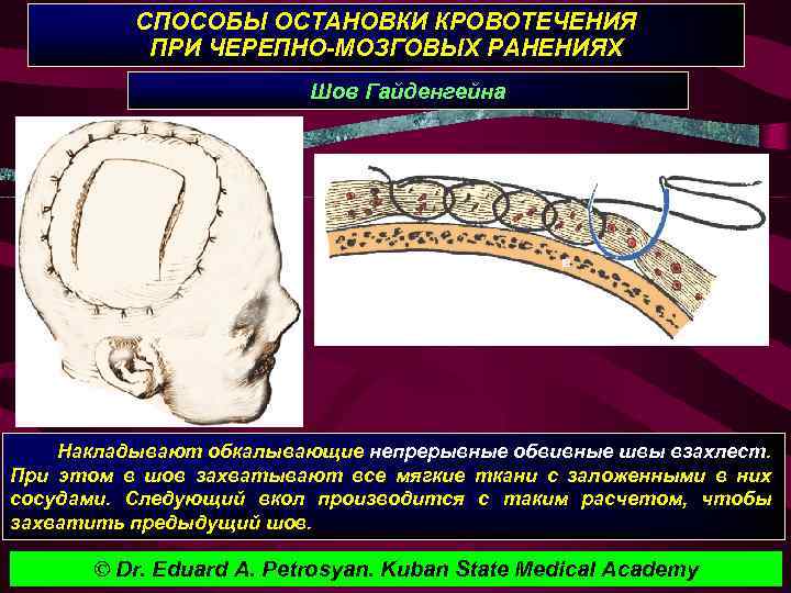 СПОСОБЫ ОСТАНОВКИ КРОВОТЕЧЕНИЯ ПРИ ЧЕРЕПНО-МОЗГОВЫХ РАНЕНИЯХ Шов Гайденгейна Накладывают обкалывающие непрерывные обвивные швы взахлест.