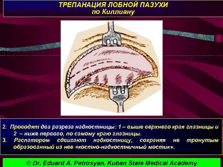 ТРЕПАНАЦИЯ ЛОБНОЙ ПАЗУХИ по Киллиану 2. Проводят два разреза надкостницы: 1 – выше верхнего