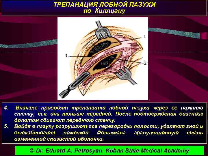 ТРЕПАНАЦИЯ ЛОБНОЙ ПАЗУХИ по Киллиану 4. Вначале проводят трепанацию лобной пазухи через ее нижнюю