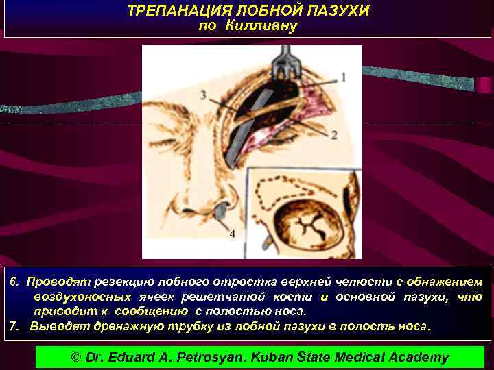 ТРЕПАНАЦИЯ ЛОБНОЙ ПАЗУХИ по Киллиану 6. Проводят резекцию лобного отростка верхней челюсти с обнажением