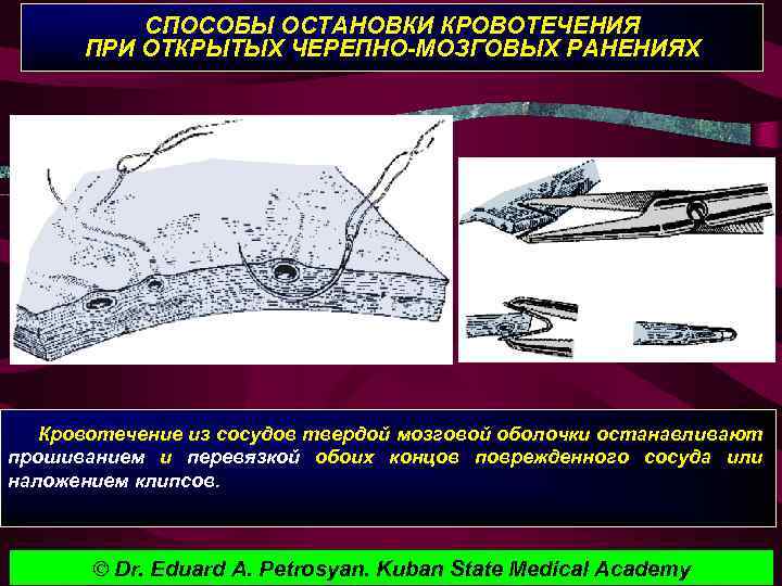 СПОСОБЫ ОСТАНОВКИ КРОВОТЕЧЕНИЯ ПРИ ОТКРЫТЫХ ЧЕРЕПНО-МОЗГОВЫХ РАНЕНИЯХ Кровотечение из сосудов твердой мозговой оболочки останавливают