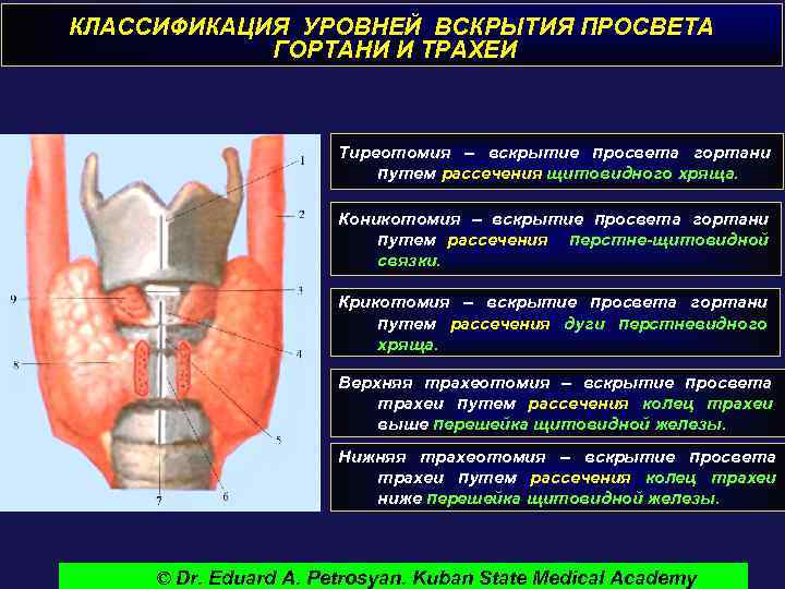 КЛАССИФИКАЦИЯ УРОВНЕЙ ВСКРЫТИЯ ПРОСВЕТА ГОРТАНИ И ТРАХЕИ Тиреотомия – вскрытие просвета гортани путем рассечения