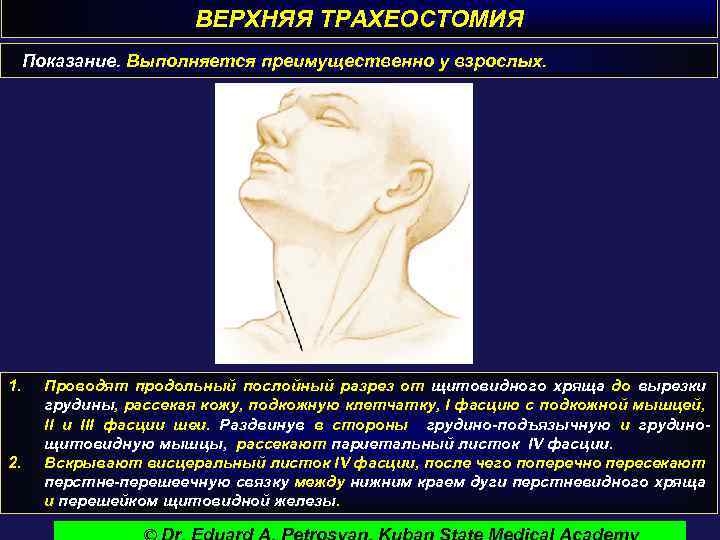 ВЕРХНЯЯ ТРАХЕОСТОМИЯ Показание. Выполняется преимущественно у взрослых. 1. 2. Проводят продольный послойный разрез от