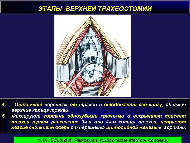 ЭТАПЫ ВЕРХНЕЙ ТРАХЕОСТОМИИ 4. 5. Отделяют перешеек от трахеи и отодвигают его книзу, обнажая