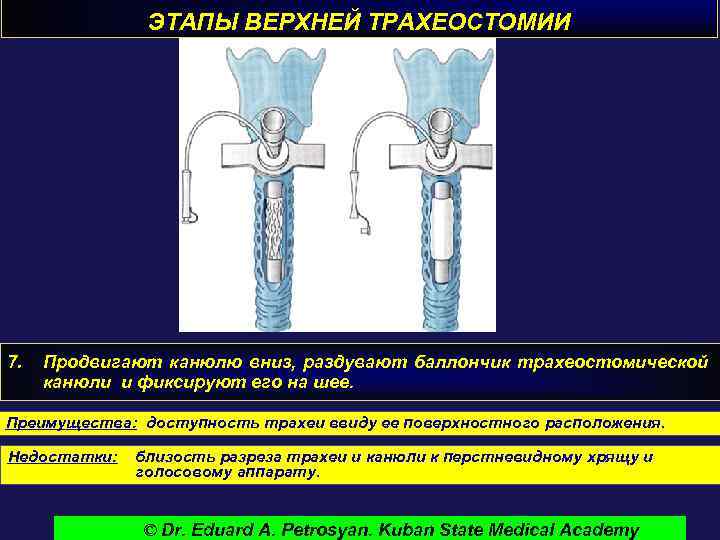 ЭТАПЫ ВЕРХНЕЙ ТРАХЕОСТОМИИ 7. Продвигают канюлю вниз, раздувают баллончик трахеостомической канюли и фиксируют его