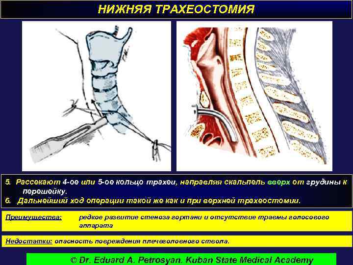 НИЖНЯЯ ТРАХЕОСТОМИЯ 5. Рассекают 4 -ое или 5 -ое кольцо трахеи, направляя скальпель вверх