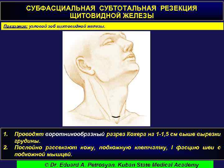 СУБФАСЦИАЛЬНАЯ СУБТОТАЛЬНАЯ РЕЗЕКЦИЯ ЩИТОВИДНОЙ ЖЕЛЕЗЫ Показание: узловой зоб щитовидной железы. 1. 2. Проводят воротникообразный
