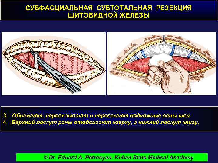 СУБФАСЦИАЛЬНАЯ СУБТОТАЛЬНАЯ РЕЗЕКЦИЯ ЩИТОВИДНОЙ ЖЕЛЕЗЫ 3. Обнажают, перевязывают и пересекают подкожные вены шеи. 4.