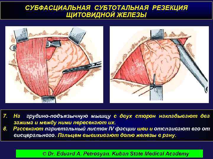 СУБФАСЦИАЛЬНАЯ СУБТОТАЛЬНАЯ РЕЗЕКЦИЯ ЩИТОВИДНОЙ ЖЕЛЕЗЫ 7. 8. На грудино-подъязычную мышцу с двух сторон накладывают