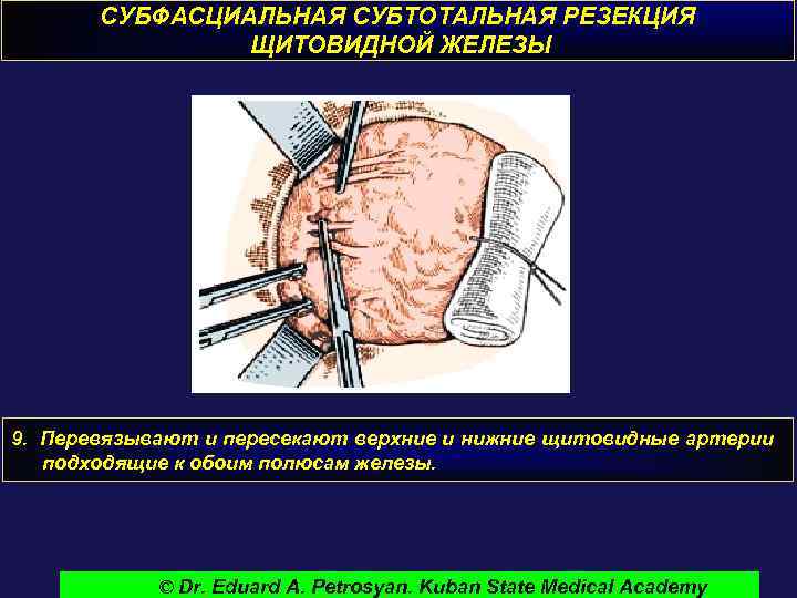 СУБФАСЦИАЛЬНАЯ СУБТОТАЛЬНАЯ РЕЗЕКЦИЯ ЩИТОВИДНОЙ ЖЕЛЕЗЫ 9. Перевязывают и пересекают верхние и нижние щитовидные артерии