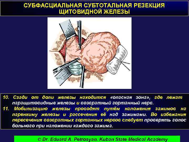 СУБФАСЦИАЛЬНАЯ СУБТОТАЛЬНАЯ РЕЗЕКЦИЯ ЩИТОВИДНОЙ ЖЕЛЕЗЫ 10. Сзади от доли железы находится «опасная зона» ,