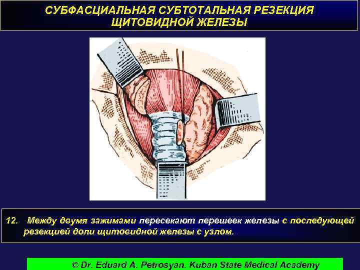 СУБФАСЦИАЛЬНАЯ СУБТОТАЛЬНАЯ РЕЗЕКЦИЯ ЩИТОВИДНОЙ ЖЕЛЕЗЫ 12. Между двумя зажимами пересекают перешеек железы с последующей