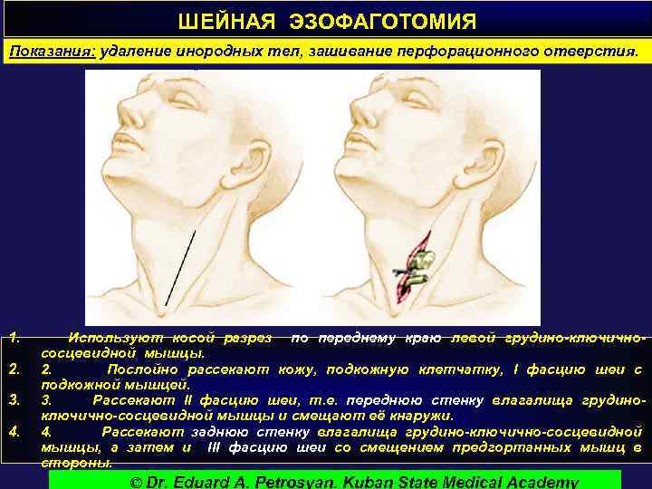 ШЕЙНАЯ ЭЗОФАГОТОМИЯ Показания: удаление инородных тел, зашивание перфорационного отверстия. 1. 2. 3. 4. Используют