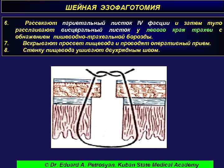 ШЕЙНАЯ ЭЗОФАГОТОМИЯ 6. 7. 8. Рассекают париетальный листок IV фасции и затем тупо расслаивают