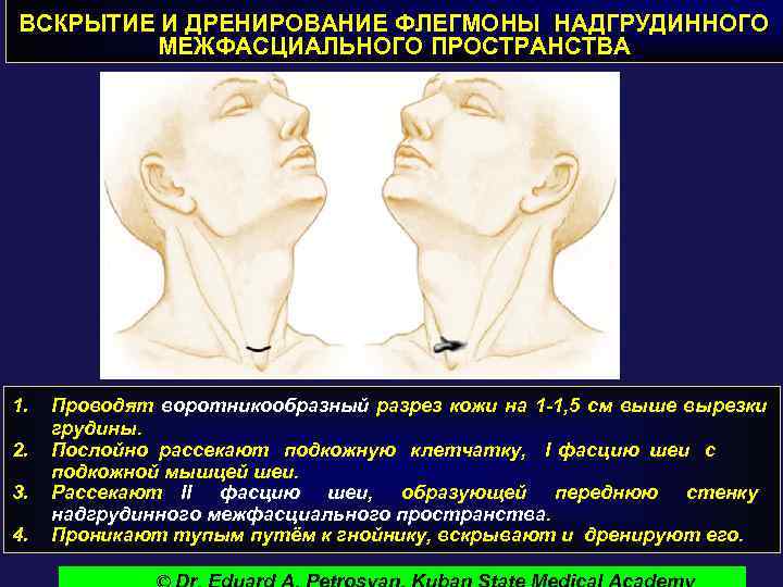 ВСКРЫТИЕ И ДРЕНИРОВАНИЕ ФЛЕГМОНЫ НАДГРУДИННОГО МЕЖФАСЦИАЛЬНОГО ПРОСТРАНСТВА 1. 2. 3. 4. Проводят воротникообразный разрез