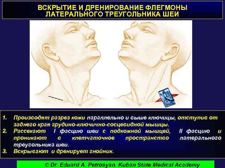 ВСКРЫТИЕ И ДРЕНИРОВАНИЕ ФЛЕГМОНЫ ЛАТЕРАЛЬНОГО ТРЕУГОЛЬНИКА ШЕИ 1. 2. 3. Производят разрез кожи параллельно