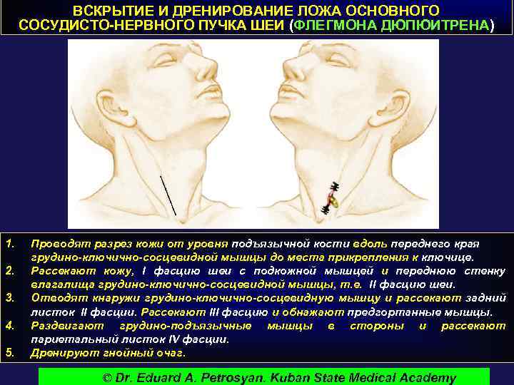 ВСКРЫТИЕ И ДРЕНИРОВАНИЕ ЛОЖА ОСНОВНОГО СОСУДИСТО-НЕРВНОГО ПУЧКА ШЕИ (ФЛЕГМОНА ДЮПЮИТРЕНА) 1. 2. 3. 4.