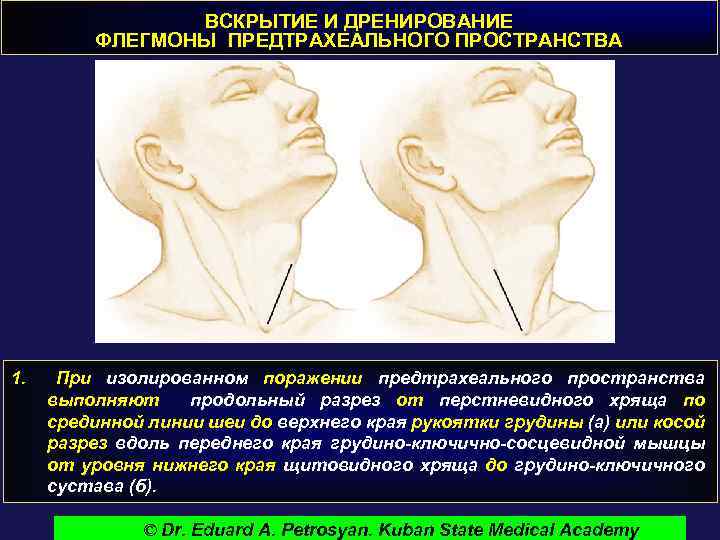 ВСКРЫТИЕ И ДРЕНИРОВАНИЕ ФЛЕГМОНЫ ПРЕДТРАХЕАЛЬНОГО ПРОСТРАНСТВА 1. При изолированном поражении предтрахеального пространства выполняют продольный