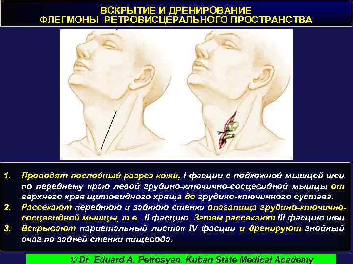 ВСКРЫТИЕ И ДРЕНИРОВАНИЕ ФЛЕГМОНЫ РЕТРОВИСЦЕРАЛЬНОГО ПРОСТРАНСТВА 1. 2. 3. Проводят послойный разрез кожи, I