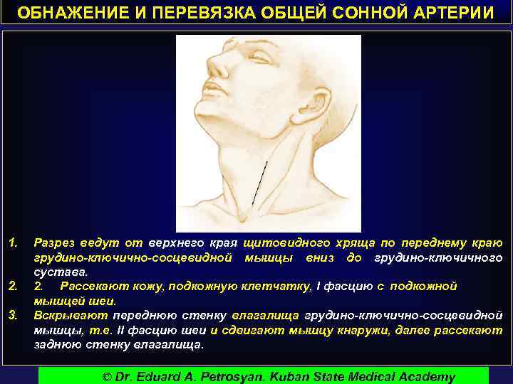 ОБНАЖЕНИЕ И ПЕРЕВЯЗКА ОБЩЕЙ СОННОЙ АРТЕРИИ 1. 2. 3. Разрез ведут от верхнего края